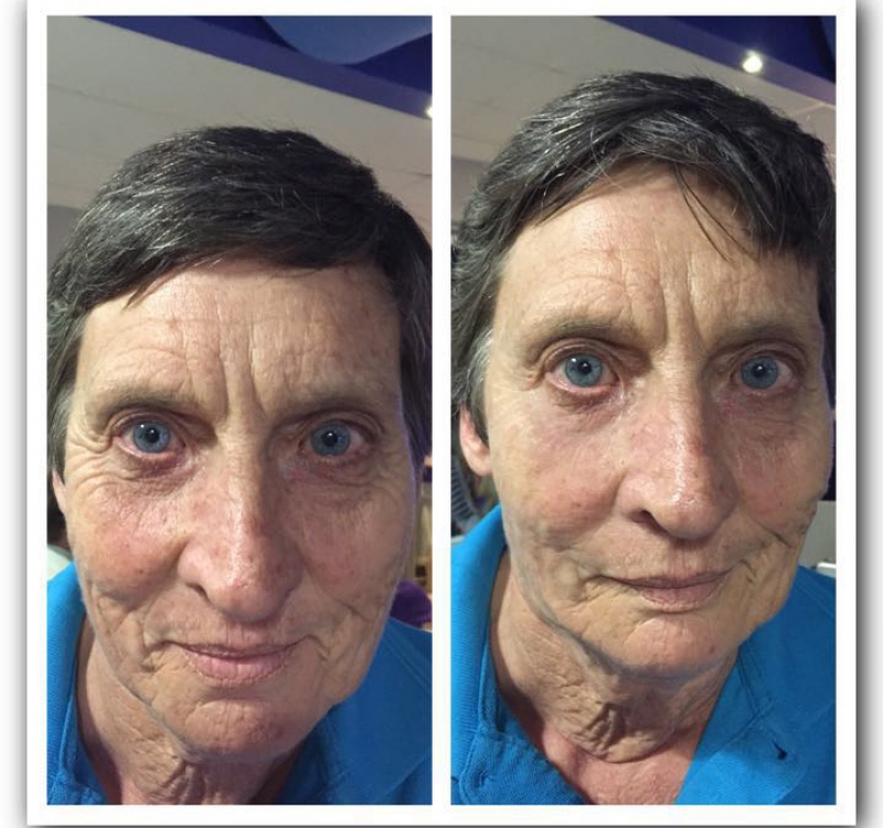 Anti ageless result 2 Results of Anti Ageles