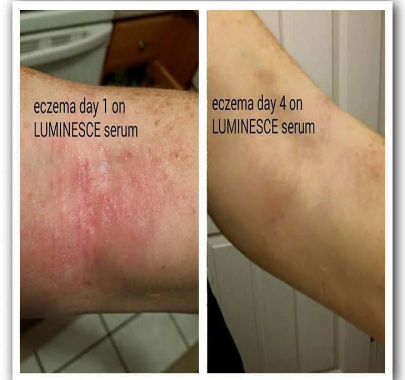 Eczema result Eczema result