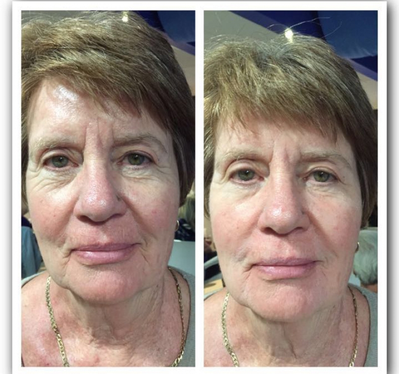 Results of Anti Ageless product 1 Results of Anti Ageles